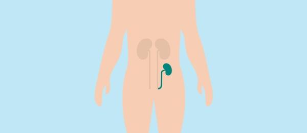 Illustration of a kidney transplant